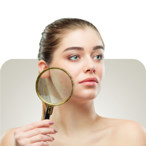 Category Acne Prone Skin image